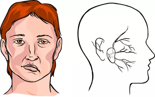 Co giật cơ mặt là một dấu hiệu của méo miệng
